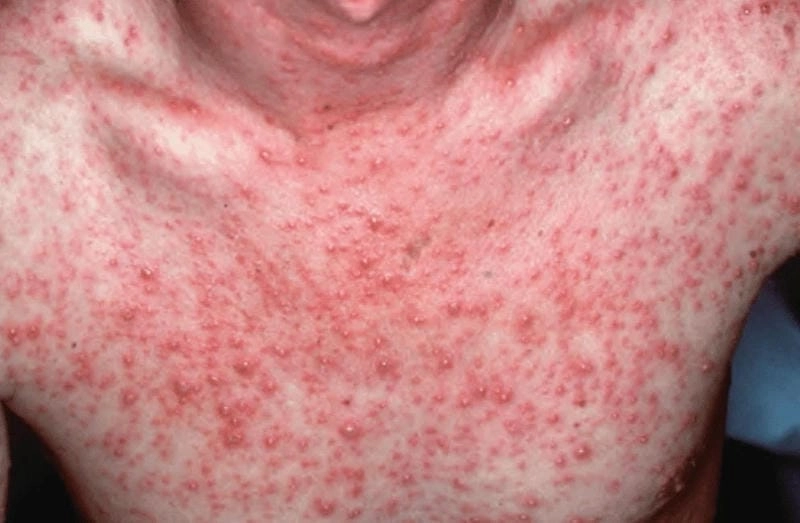 Hình ảnh mụn thuỷ đậu có đầu trắng và dễ vỡ