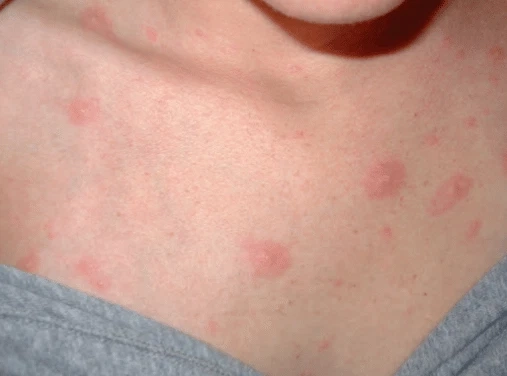 Hình ảnh thuỷ đậu bị bội nhiễm có vết loét và mủ vàng