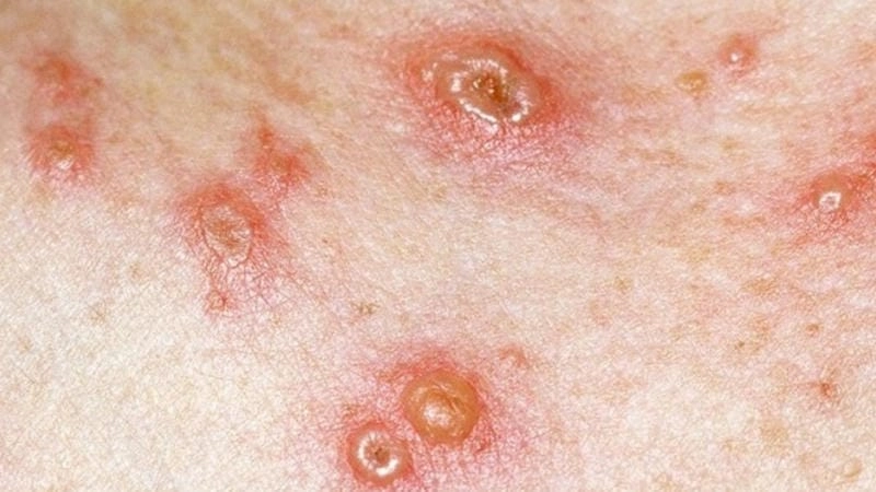 Hình ảnh nốt thuỷ đậu nhỏ mịn sau đó phồng và vỡ nước