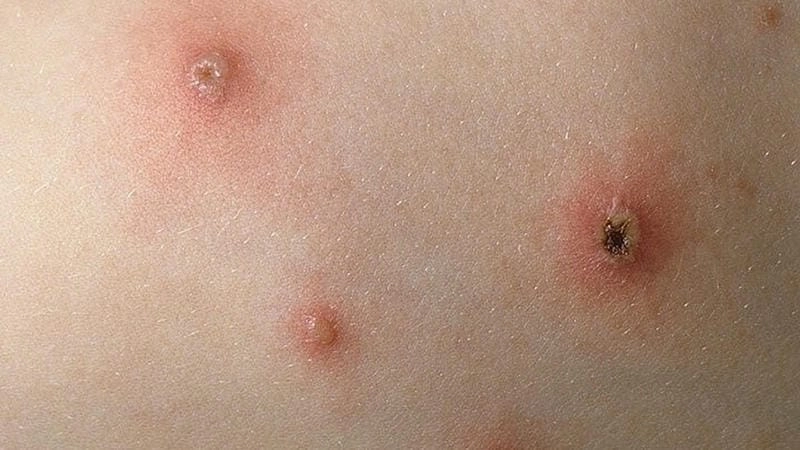 Dấu hiệu hình ảnh bệnh thủy đậu ở người lớn là sốt và mẩn đỏ