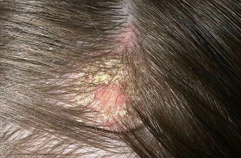 Hình ảnh bệnh vảy nến da đầu giúp chẩn đoán nhanh