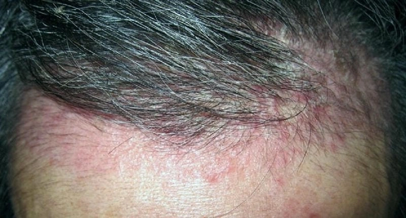 Da đầu bị vảy có thể là dấu hiệu vảy nến