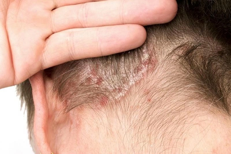 Da đầu vảy nến khiến tóc dễ rụng và khô