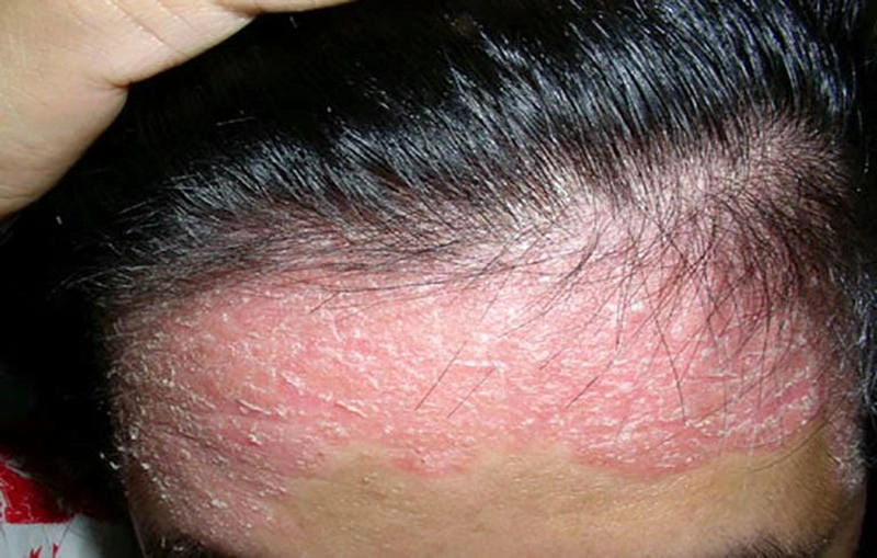 Hình ảnh vảy nến da đầu giúp nhận biết sớm