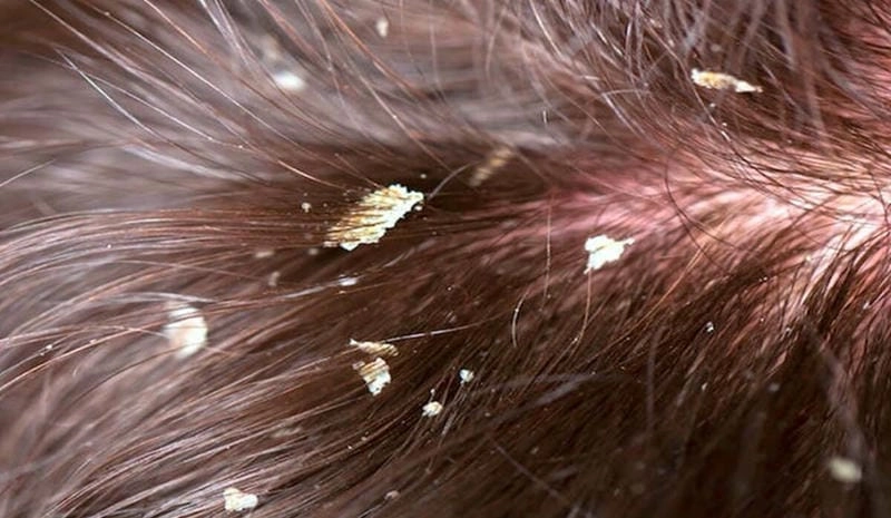Vảy nến da đầu ở người lớn thường kéo dài và tái phát