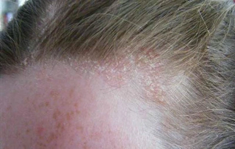 Hình ảnh người bị vảy nến da đầu cho thấy vùng viêm đỏ