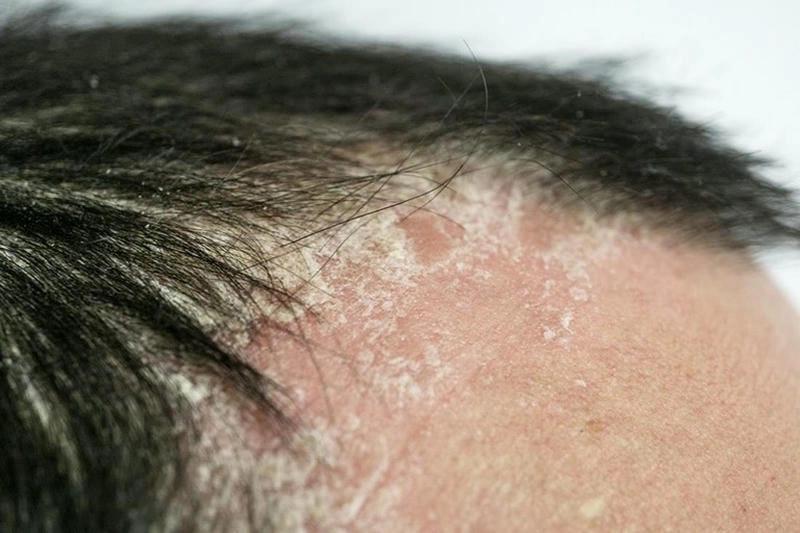 Ảnh trẻ bị vảy nến ở da đầu cảnh báo dấu hiệu sớm