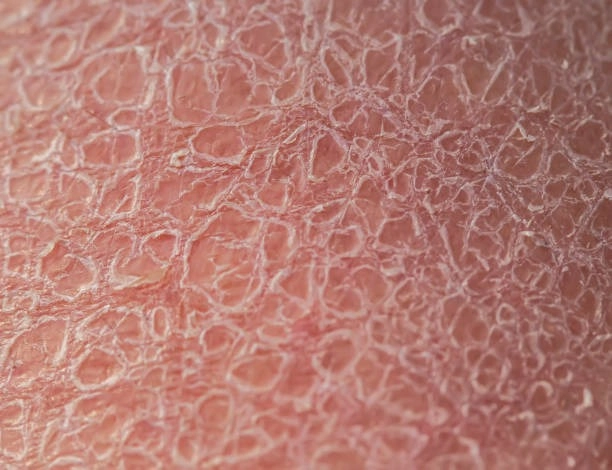 Triệu chứng của bệnh da vảy cá qua hình ảnh