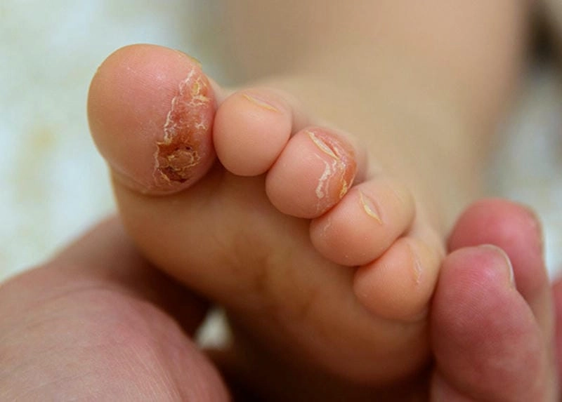 Nhận diện bệnh vảy cá ở chân qua hình ảnh