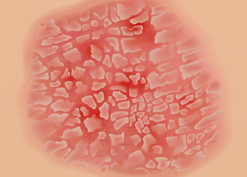 Ảnh minh họa chân bị vảy cá rõ ràng