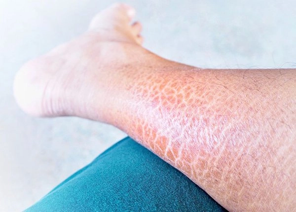 Tìm hiểu nguyên nhân da chân bị vảy cá