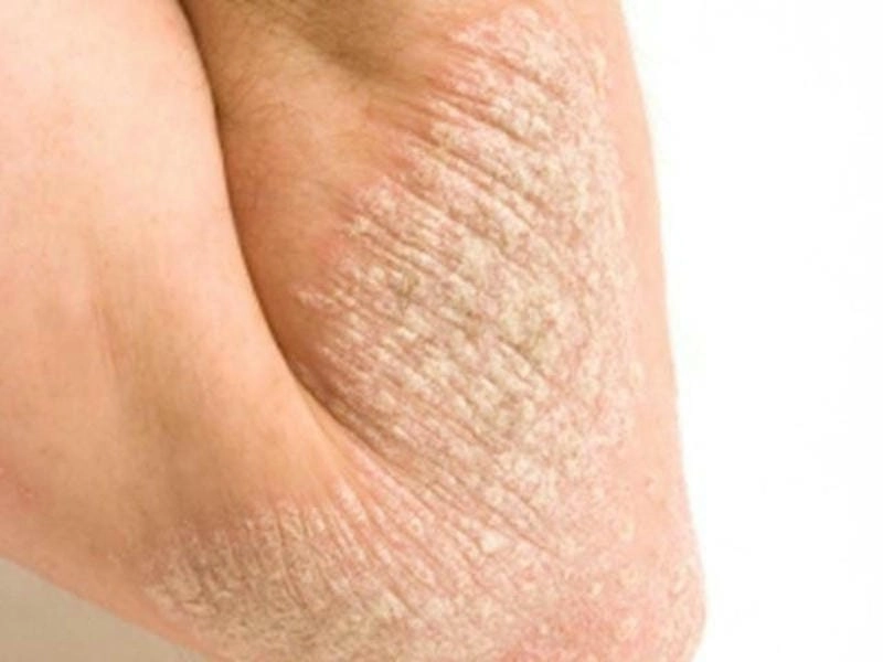 Tổng quan về hình ảnh bệnh vảy cá ở da