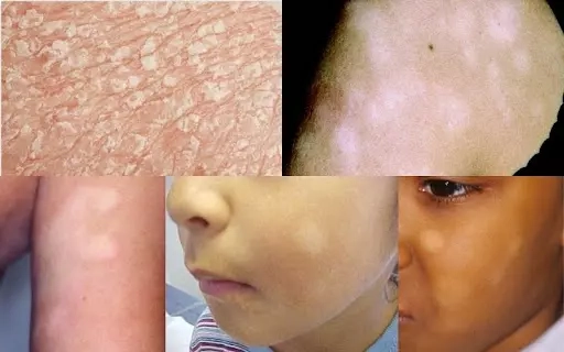 Xem rõ hình ảnh bệnh vảy cá điển hình nhất