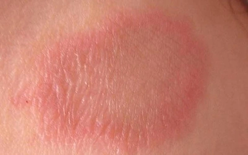 Quan sát bệnh da khô vảy cá qua ảnh thực