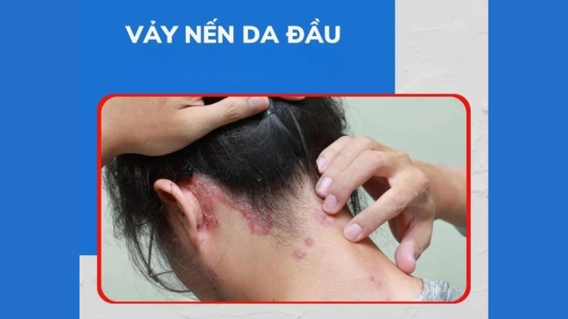 Nhận biết sớm qua hình ảnh bệnh vảy nến da đầu