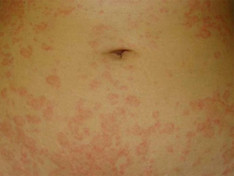 Vảy nến phấn hồng xuất hiện đột ngột