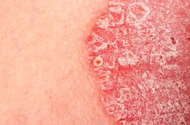 Diễn biến lâm sàng vảy nến phấn hồng theo giai đoạn