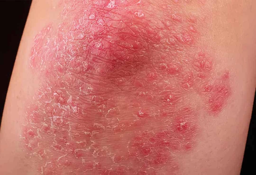 Tìm hiểu ảnh người bị bệnh vảy nến phấn hồng cụ thể