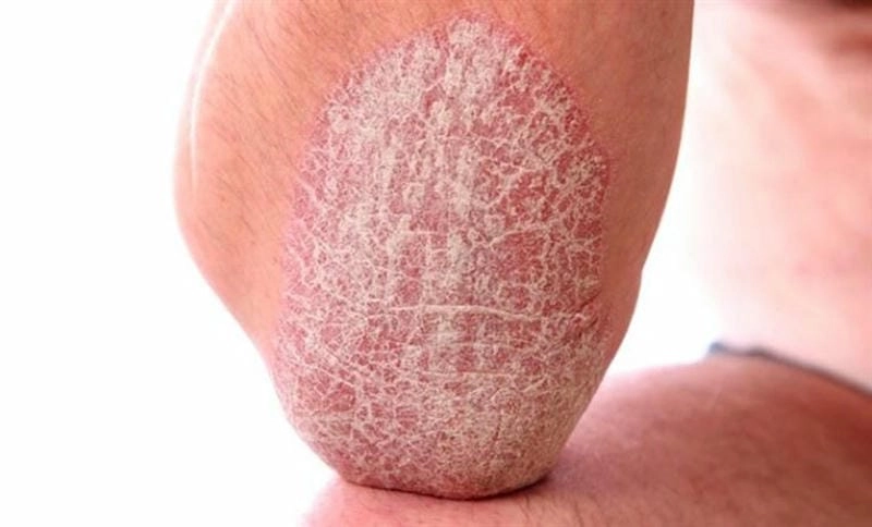 Nhận biết ảnh trẻ bị vảy nến phấn hồng dễ dàng