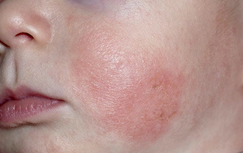 Nguyên nhân gây vảy nến phấn hồng là gì