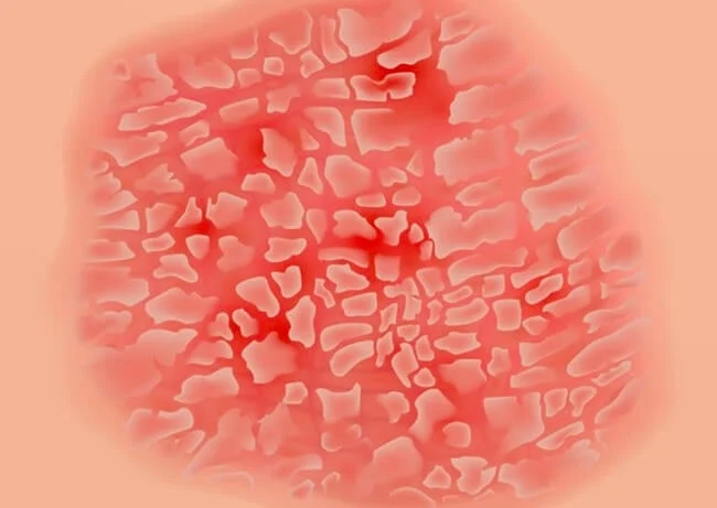 Xem chi tiết hình ảnh bệnh vảy phấn hồng rõ nét