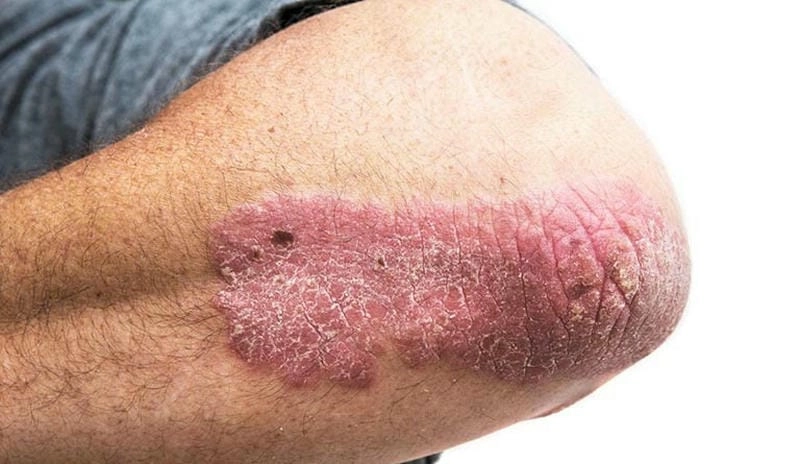 Phân biệt vảy phấn hồng và vảy nến chính xác