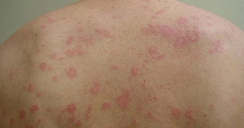 Hình ảnh rõ nét vảy nến hồng gibert