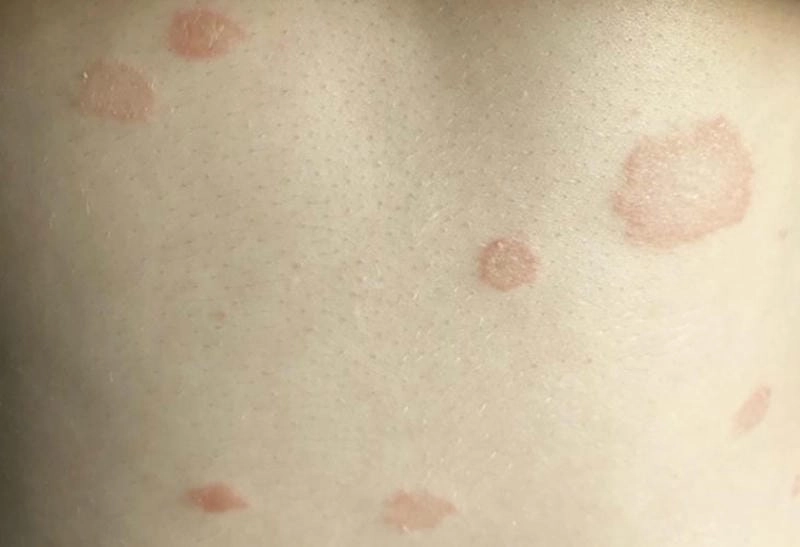 Tổng hợp ảnh bệnh vảy nến phấn hồng thực tế