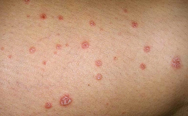 Xem rõ ảnh người bị vảy nến phấn hồng chi tiết