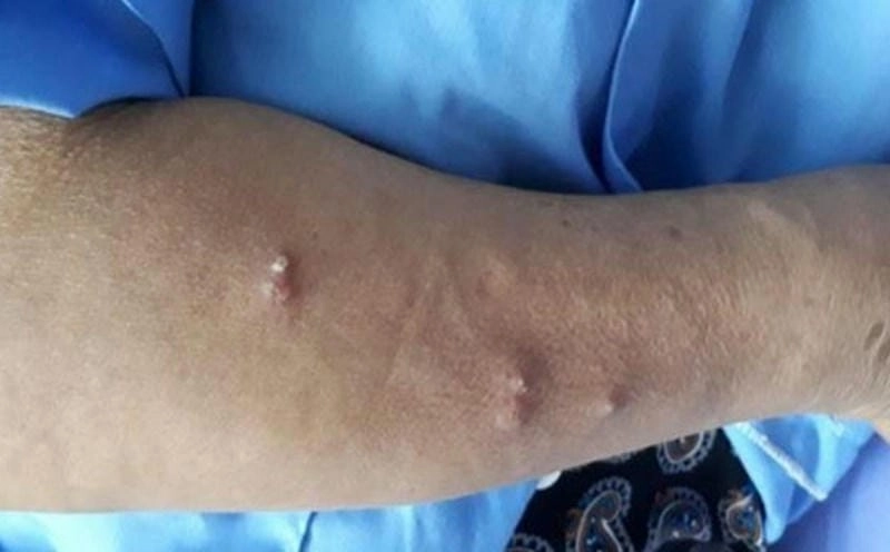 Khám phá hình ảnh bệnh vi khuẩn ăn thịt người mới nhất