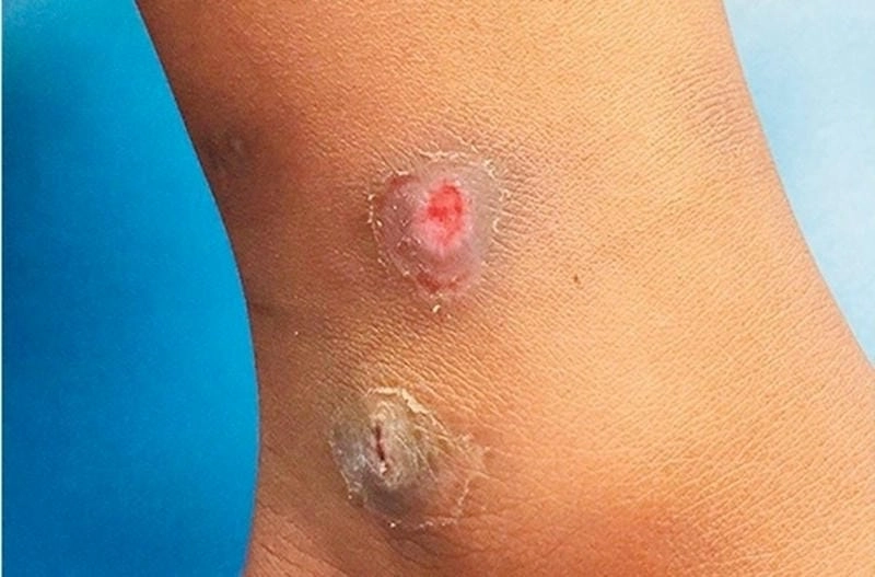 Nguy cơ từ bệnh vi rút ăn thịt người không thể xem nhẹ