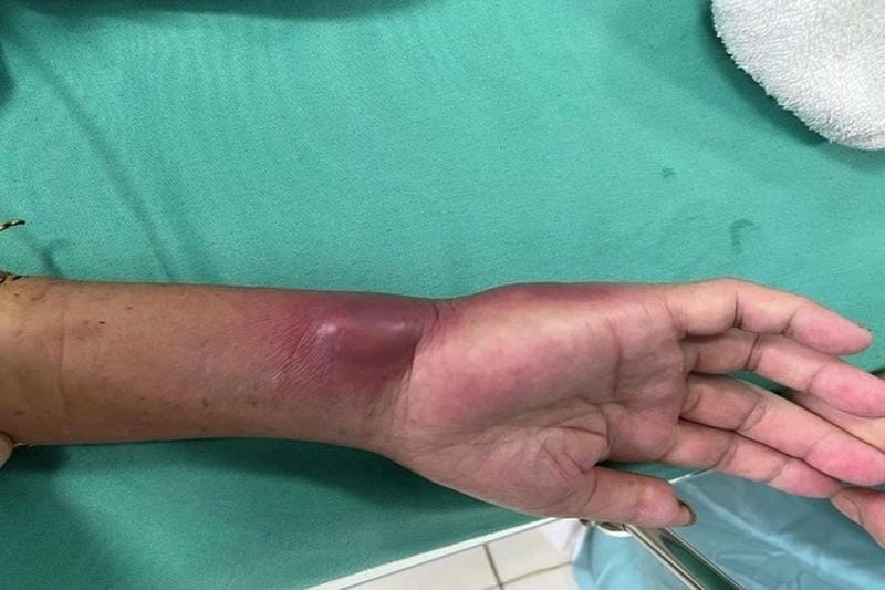 Triệu chứng khi nhiễm vi khuẩn ăn thịt người cấp tính