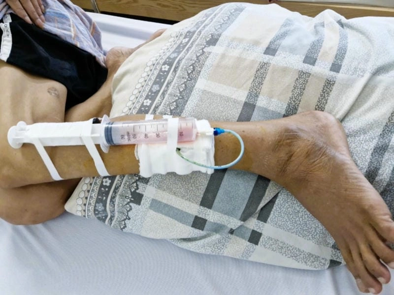 Các triệu chứng vi khuẩn ăn thịt người không thể bỏ qua