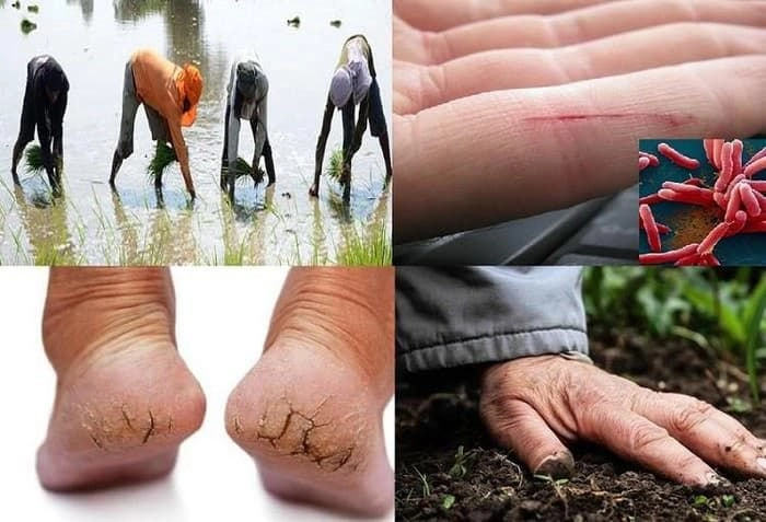 Hiểu rõ nguy cơ từ vi khuẩn ăn thịt người để bảo vệ bản thân