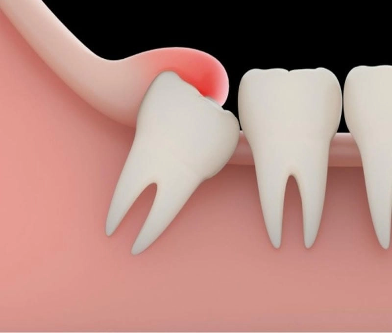 Tình trạng rõ ràng qua hình ảnh người bị viêm nướu