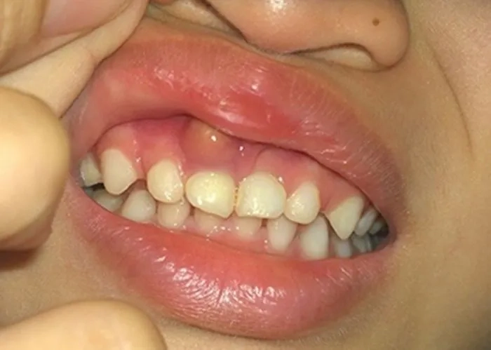 Đừng chủ quan trước ảnh nướu răng bị viêm