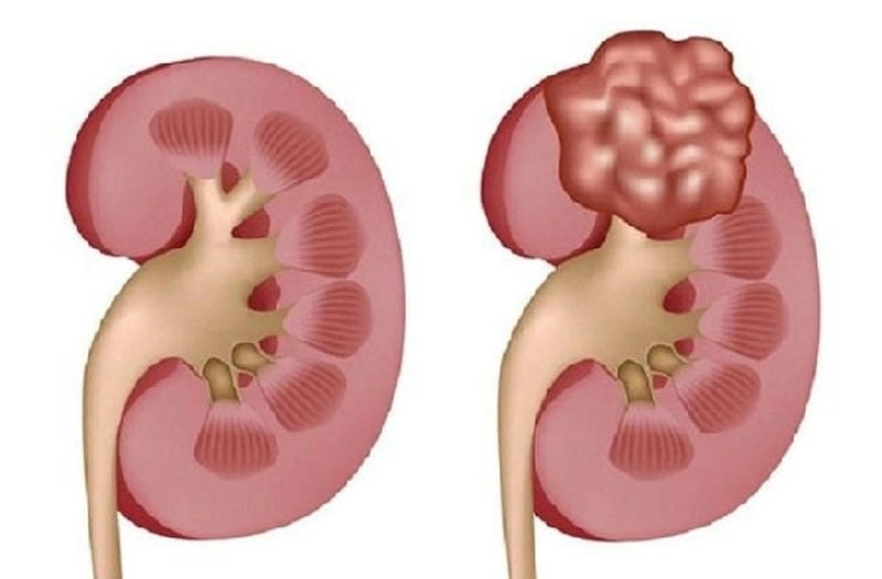 Xem ngay hình ảnh bệnh viêm cầu thận người bị mắc bệnh
