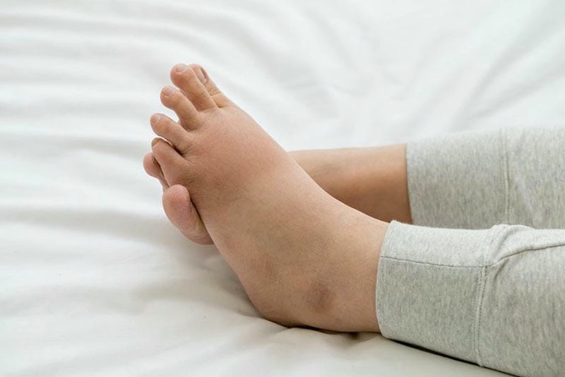 Nhận biết hình ảnh bệnh viêm cầu thận với dấu hiệu cấp rõ ràng