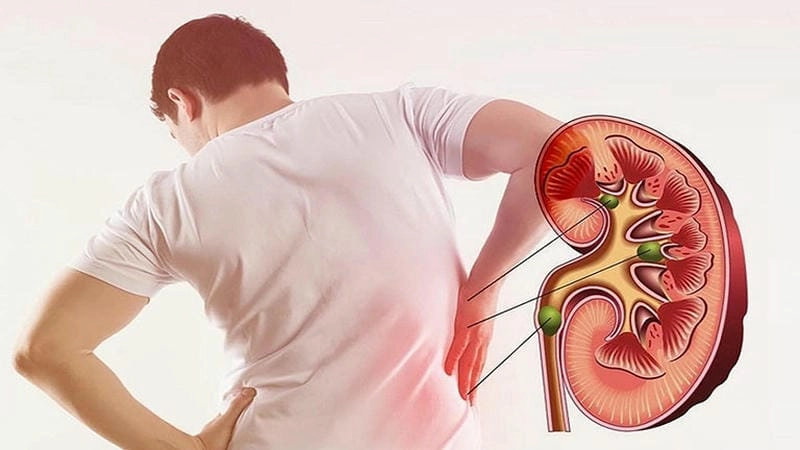 Tìm hiểu hình ảnh bệnh viêm cầu thận trong giai đoạn mạn