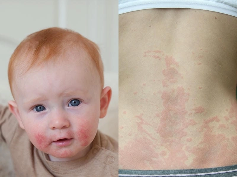 Hình ảnh về viêm da cơ địa giúp người bệnh nhận diện sớm triệu chứng