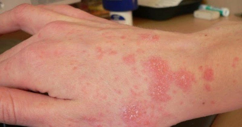 Hình ảnh viêm da cơ địa ở tay thường gặp ở mặt ngoài cánh tay
