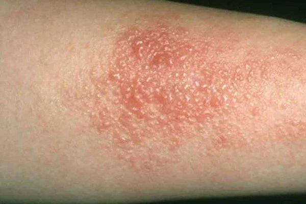 Hình ảnh bé bị viêm da cơ địa điển hình là khô nứt da vùng má