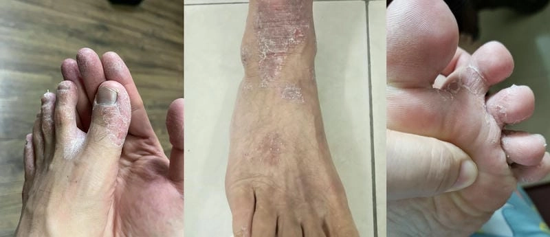Hình ảnh viêm da cơ địa ở chân thường kèm ngứa và đau rát