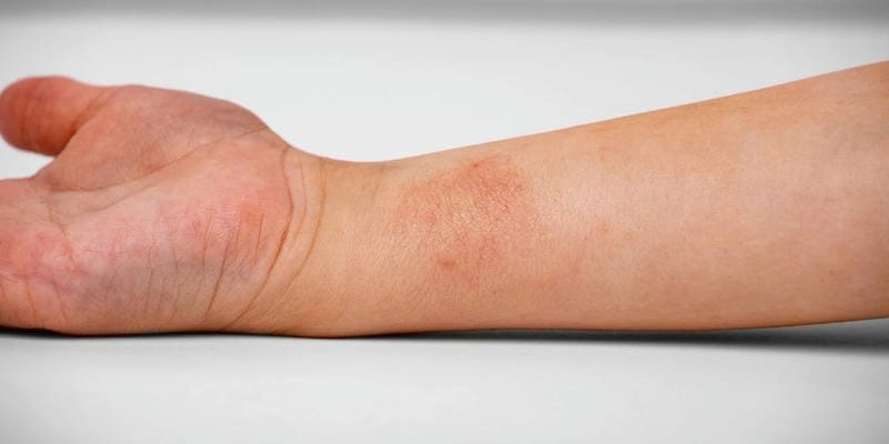 Viêm da cơ địa ở mặt người lớn có nguy cơ để lại vết thâm lâu dài