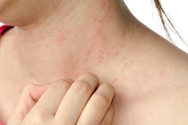 hình ảnh viêm da cơ dia giúp nhận biết bệnh lý về da nhanh chóng