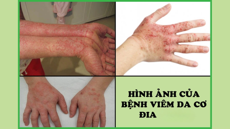 Nhận biết sớm qua hình ảnh bệnh viêm da cơ địa điển hình