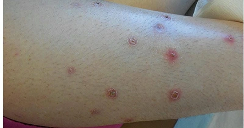 Hình ảnh về viêm da cơ địa có thể giúp nhận diện bệnh sớm