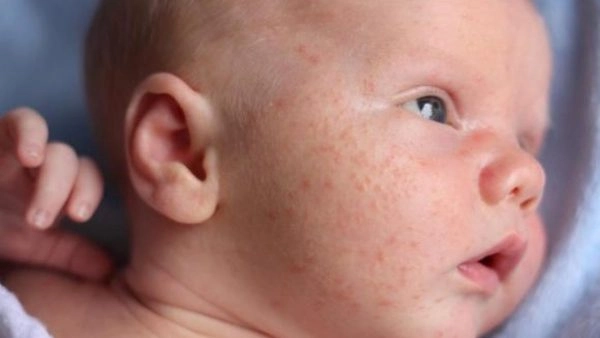 Phát hiện sớm hình ảnh viêm da mủ ở trẻ em để xử lý hiệu quả