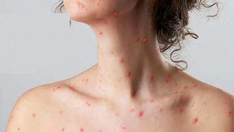 Cập nhật hình ảnh viêm da cơ địa ở người lớn để theo dõi bệnh