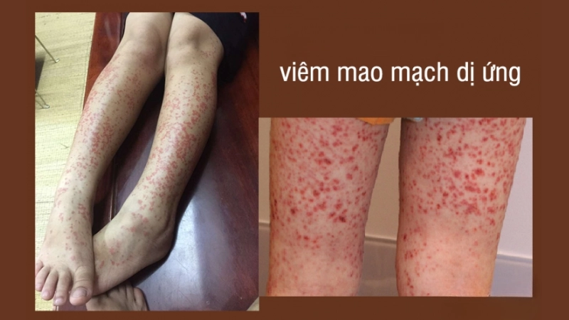 Phân tích hình ảnh bệnh viêm mao mạch dị ứng dễ hiểu nhất